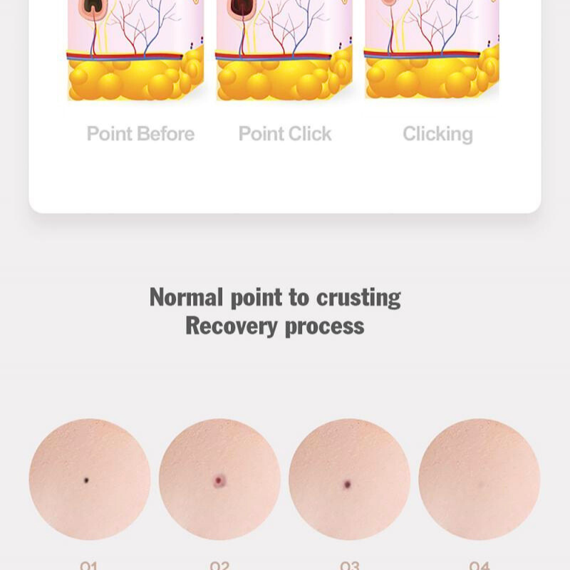 Precision Skin Tag Pen Pro - 9-Speed Ion Spot Remover with LED Light